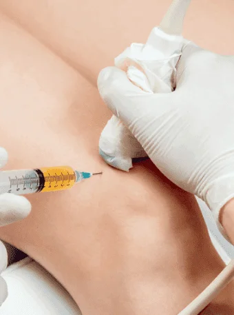 PRP terapia